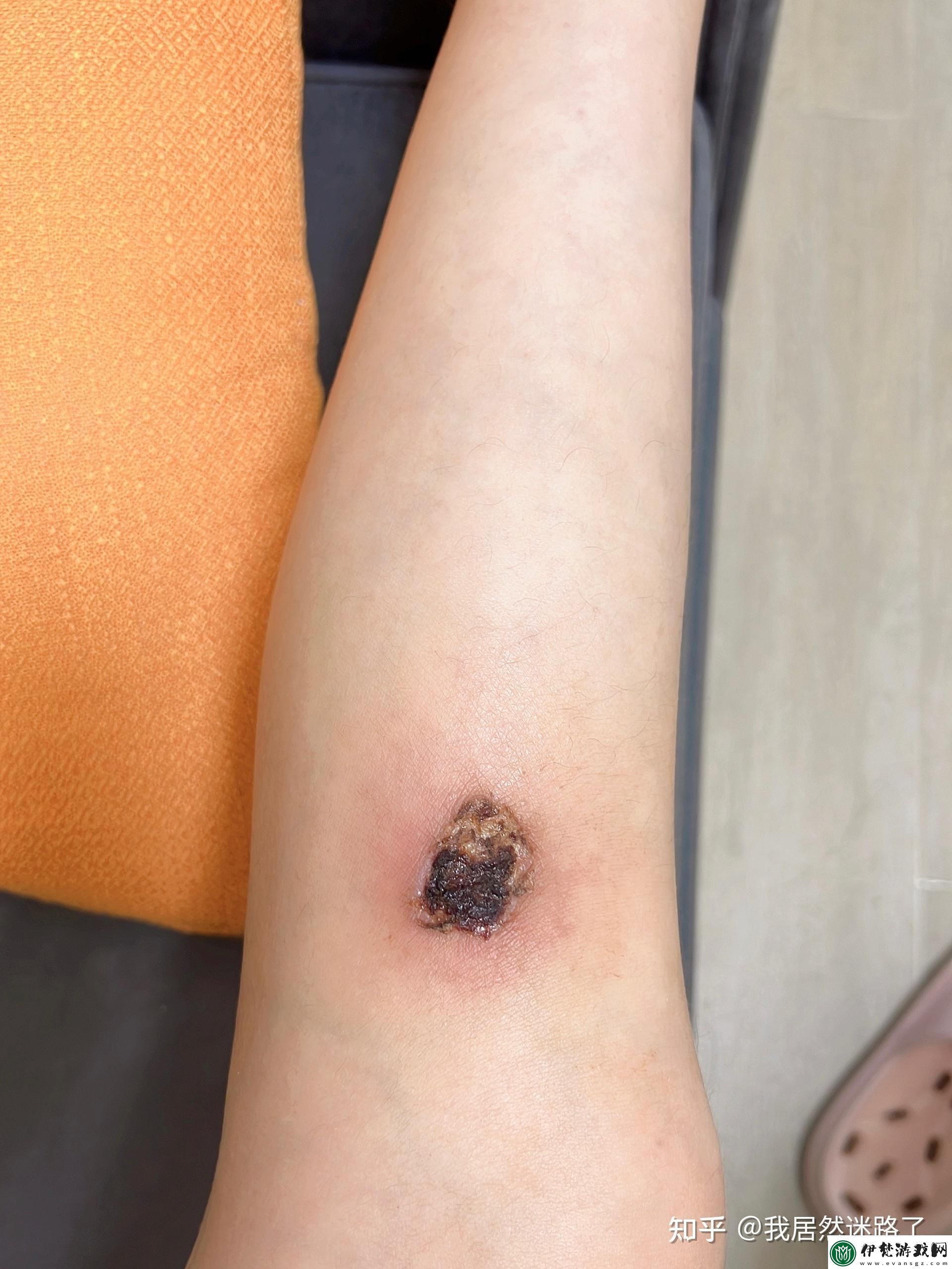 瞧瞧這科技奇觀！異物穿皮入肉